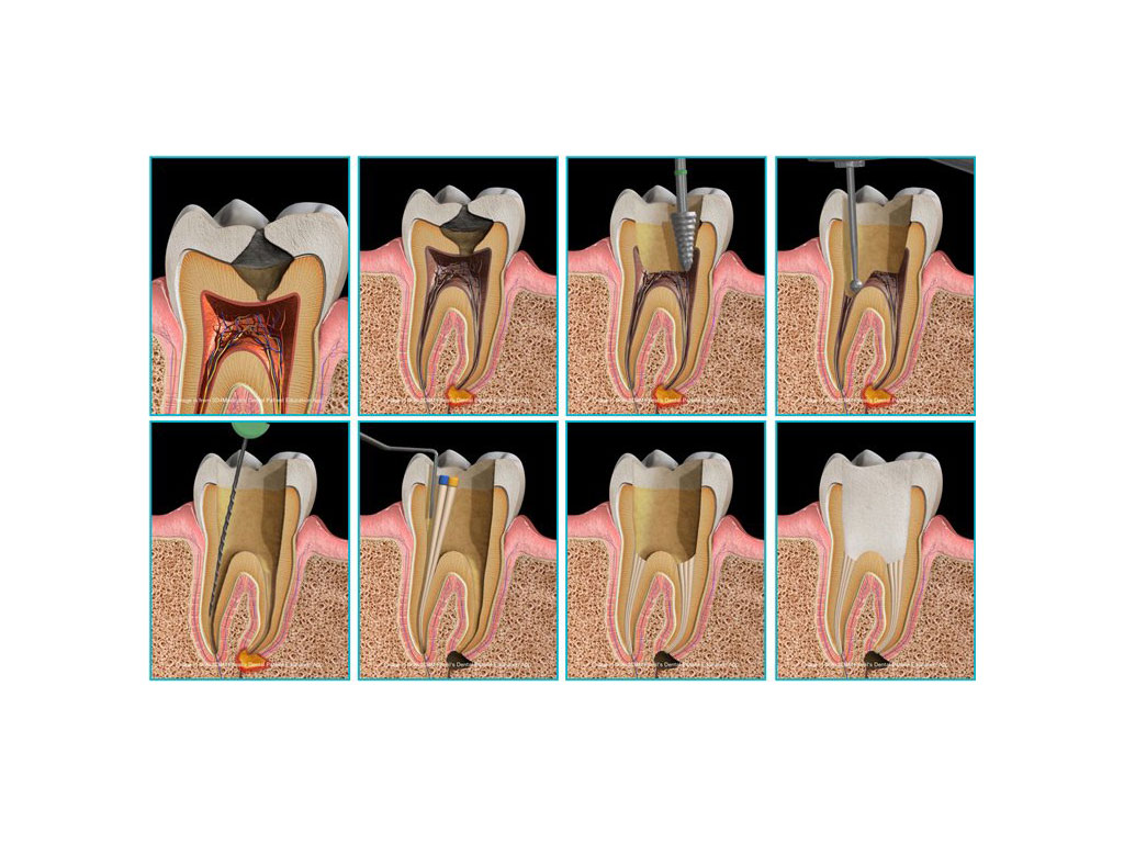 Gum Disease Treatment
