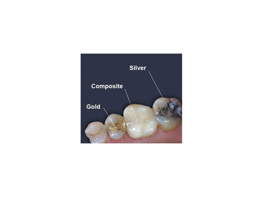 Restorative Dental Treatment (Filling Treatment)